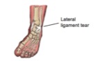 lateral ligament strain ankle