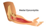 medial epicondylitis