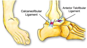 What Is Chronic Ankle Instability? - Cumberland Physiotherapy Sport ...