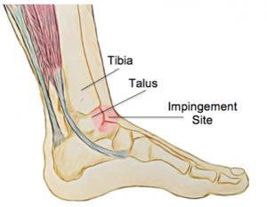 Anterior Ankle Impingement - Cumberland Physiotherapy Sport ...